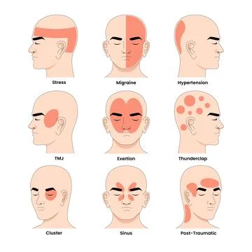 Different Types of Headache Syndrome Disorder, Educational Medical Poster D.. Stock Illustration