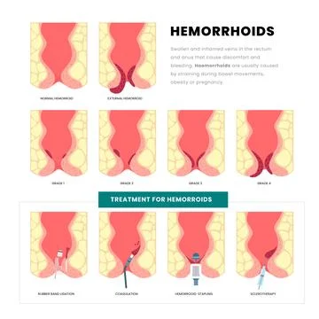 Different types of hemorrhoids disease educational poster with grade and tr.. Stock Illustration