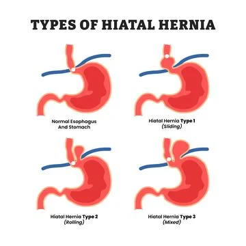 Different types of hiatal hernia types, educational medical poster design h.. Stock Illustration