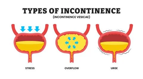 Different types of incontinence problem types, educational medical poster d.. Illustrazione stock