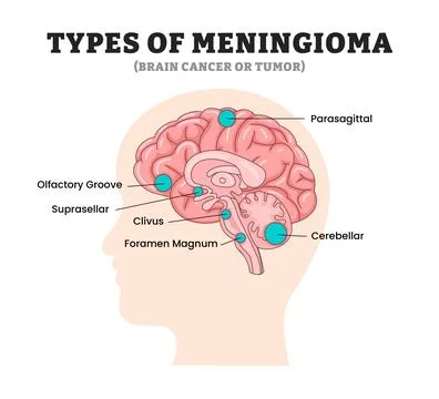 Different types of meningioma types, educational medical poster design heal.. Stock Illustration