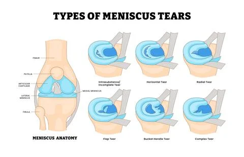 Different types of meniscus tears types, meniscal injury, educational medic.. Stock Illustration