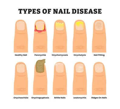 Different types of nail disease disorder types, educational medical poster .. Stock Illustration