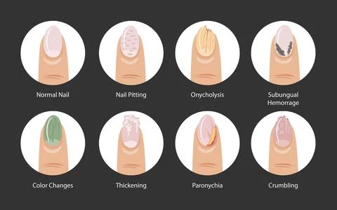 Different types of nail pitting disease set collection poster, types of nai.. Illustrazione stock