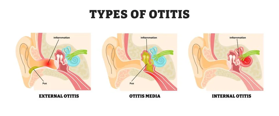 Different types of otitis types, educational medical poster design healthca.. Illustrazione stock