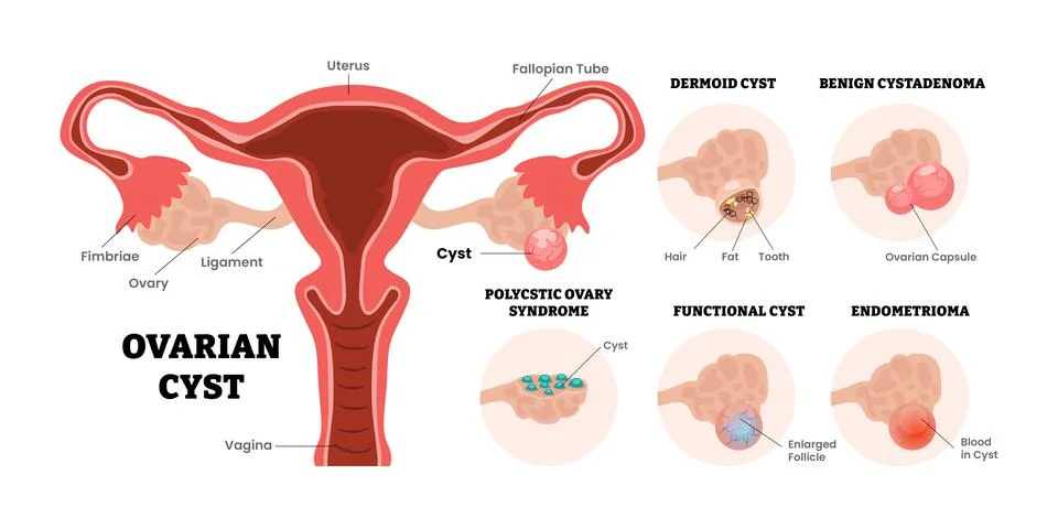 Different types of ovarian cyst types set collection, female reproductive s.. Stock Illustration