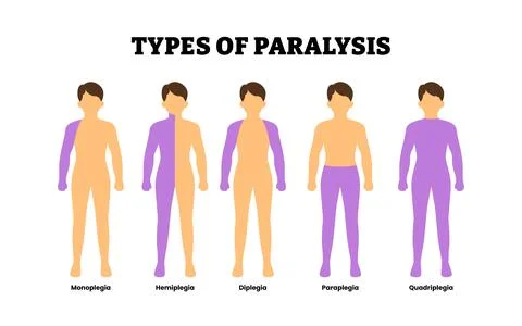 Different types of paralysis types. Labeled monoplegia, hemiplegia, diplegi.. Stock Illustration