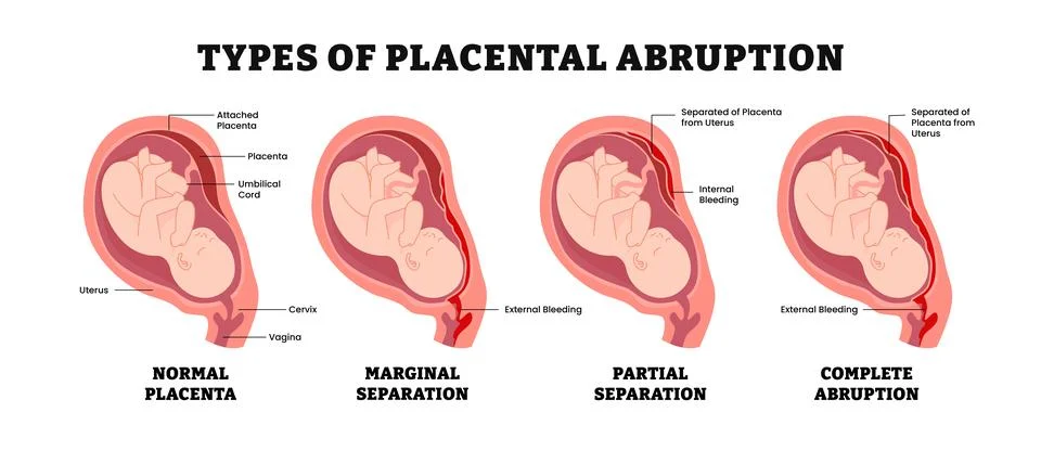 Different types of placental abruption types, educational medical poster de.. Stock Illustration