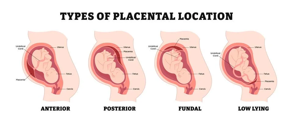 Different types of placental location types, educational medical poster des.. Stock Illustration