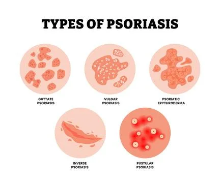 Different types of psoriasis skin derma disease. Labeled guttate, vulgar, i.. Stock-Illustration