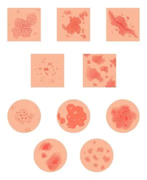 Different types of psoriasis vector set. Part of patients skin with dermatitis Stock Illustration