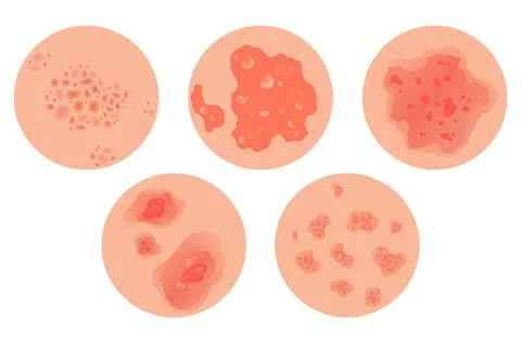 Different types of psoriasis vector set. Part of patients skin with dermatitis Stock Illustration