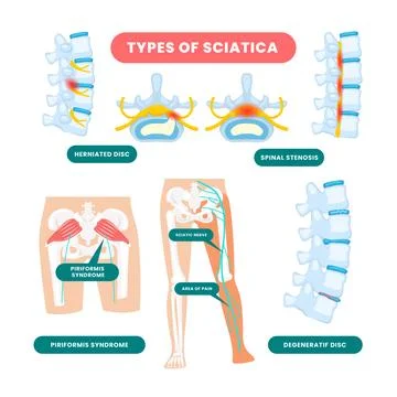 Different types of sciatica poster scheme, medical banner, Sciatica as symp.. Stock Illustration