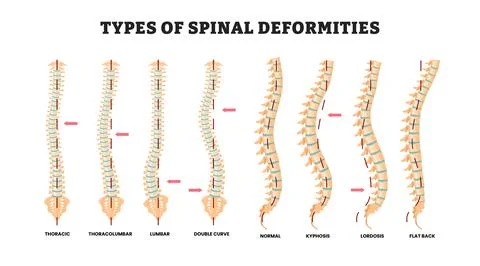 Different types of spinal deformities types, educational medical poster des.. Stock Illustration