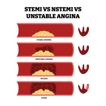 Different types of STEMI vs NSTEMI as stable angina or unstable angina type.. Stock Illustration