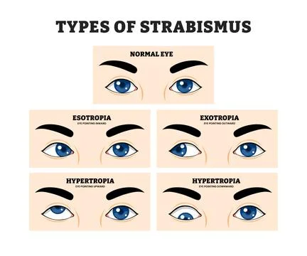 Different types of Strabismus Eye Misalignment types, educational medical p.. Stock Illustration