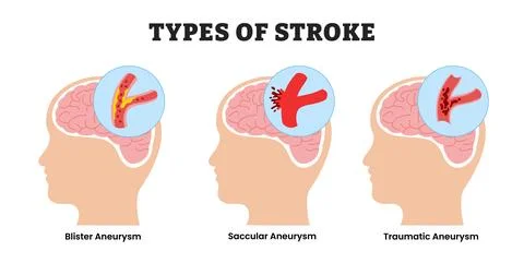 Different types of stroke types, educational medical poster design healthca.. Stock Illustration