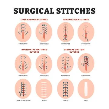 Different types of surgical stitches types, educational medical poster desi.. Stock Illustration
