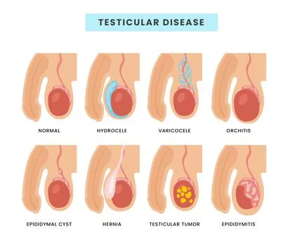 Different types of Testicular diseases types scheme male anatomy medical in.. Stock Illustration