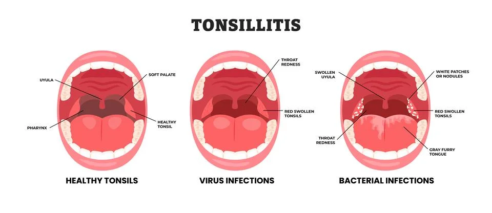 Different types of tonsillitis types, educational medical poster design hea.. Stock-Illustration
