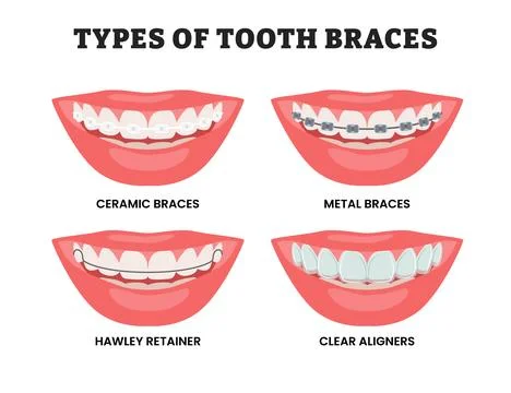 Different types of tooth braces tooh, educational medical poster design hea.. Stock Illustration
