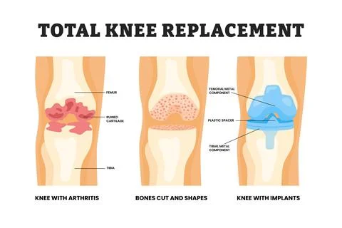 Different types of total knee replacement types, educational medical poster.. Stock Illustration