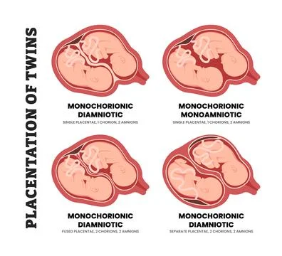 Different types of twin pregnancy or twin placentation types, educational m.. Stock Illustration