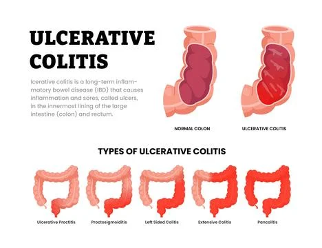 Different types of ulcerative colitis types. Labeled ulcerative proctitis, .. Stock Illustration