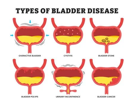 Different types of various bladder disease types, educational medical poste.. イラスト素材