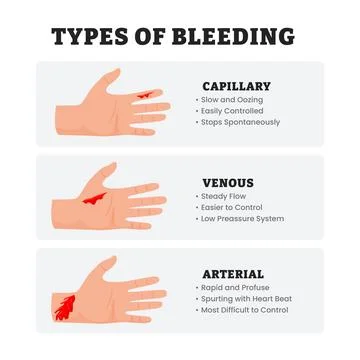 Different types of various bleeding types in hand gesture, educational medi.. Stock Illustration