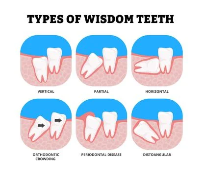 Different types of wisdom teeth types set collection. Labeled distoangular,.. Stockillustratie