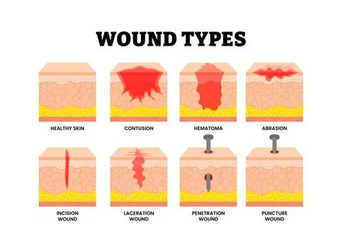Different types of wound types showing skin injury. Labeled healthy skin st.. Stock Illustration