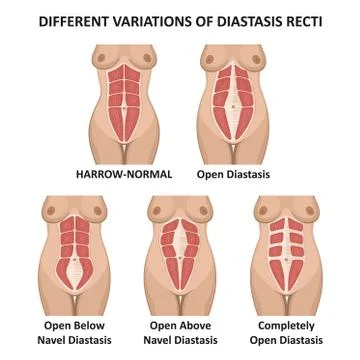 Different variations of diastasis recti Stock Illustration