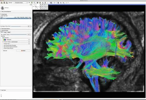 Diffusion MRI, also referred to as diffusion tensor imaging or DTI, of the human Stock Illustration