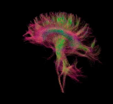 Diffusion MRI, also referred to as diffusion tensor imaging or DTI, of the human Stock Photos