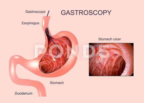 Digestive endoscopy or gastroscopy. Performing a gastroscopy procedure. Diagn Stock Illustration