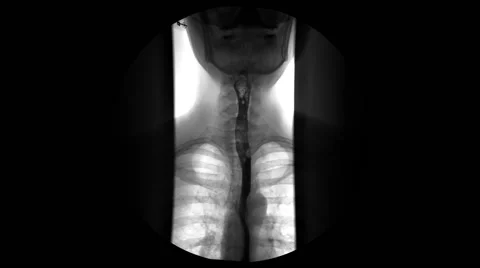 Digestive Fluoroscopy X-rays front view Stock-Footage 56347620