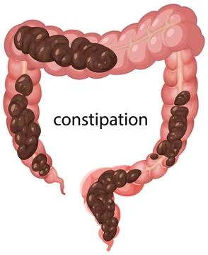 Digestive System Illustration Highlighting Constipation Stock Illustration
