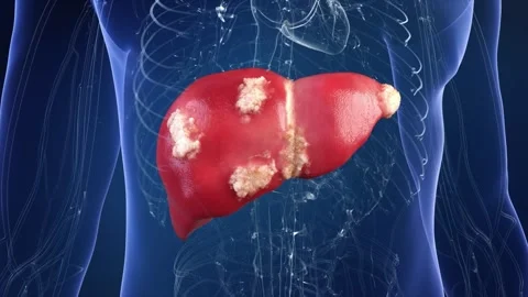 Digestive system: liver cyst, hepatitis, cirrhosis, fibrosis Stockbeeldmateriaal 345101634