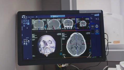 Digital Brain MRI Scan Displayed on Screen in Clinic Stock Footage 278986614