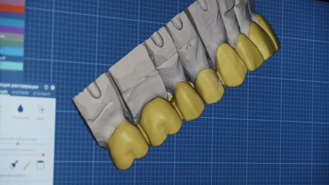 Digital dentistry designing crowns on screen 動画素材 336626764