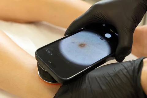 Digital Dermoscopy Examination of Mole on Human Leg Stockfoto's
