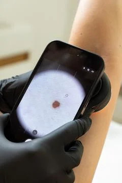 Digital Dermoscopy Examination of Mole on Human Arm Stock Photos