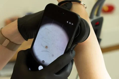 Digital Dermoscopy Examination of Mole on Human Arm Stock Photos