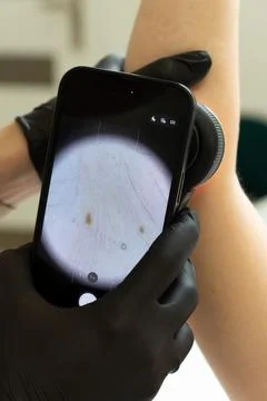Digital Dermoscopy Examination of Mole Stockfoto's