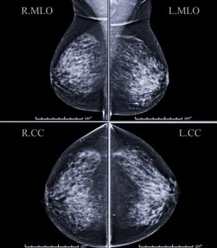 Digital Mammogram both side CC view and MLO of breast for finding Breast canc Illustrazione stock