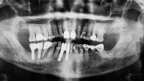 Digital x-ray of teeth profile with root canal, fillings and orthodontic impl Stock Photos