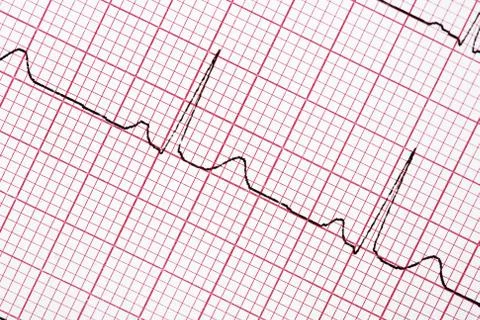 Digitally recorded ECG graph - electrocardiogram Stock Photos
