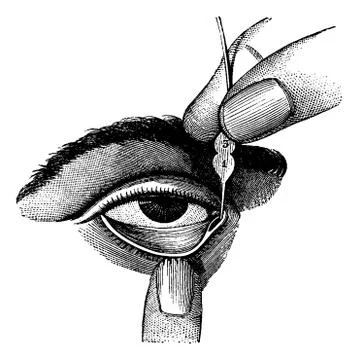 Dilation of Lacrimal Duct Using Probes, vintage engraving Stock Illustration