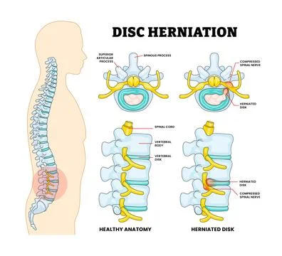 Disc Herniation with Spinal Bone Spine Disease Educational Medical Poster D.. Stock Illustration